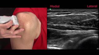 Ultrasound of the Shoulder [upl. by Ahkihs]