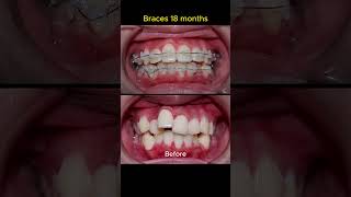 Braces process in 18 months [upl. by Ahsimrac455]