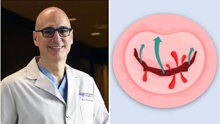 Mitral Valve Disease The Different Faces amp Treatment Options [upl. by Znerol]