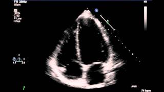 Echocardiogram [upl. by Ielerol]