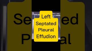 Septated Pleural Effusion  Lung Fluid  Dyspnoea ultrasound [upl. by Ilyah487]