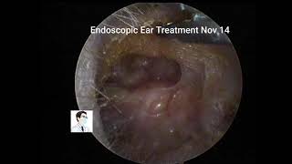 Two cases of middle ear cholesteatoma with postoperative debridement [upl. by Nyra]