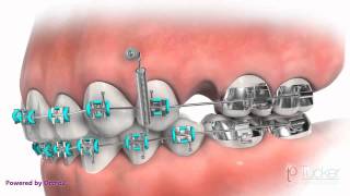 Orthodontic MiniImplant TAD or TSA [upl. by Fanya]