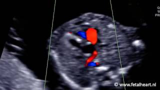 Fetal heart Academy  HLHS AoS 2 Foramen ovale color Doppler [upl. by Segal259]