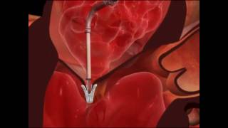 Mitral Valve Clip Repair ProcedureHow It Works [upl. by Asenev]