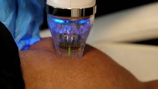 RF Microneedling for stretch marks VIDEO N5 [upl. by Ytte]