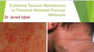 Erythema Toxicum Neonatorum VS Transient Neonatal Pustular Melanosis [upl. by Horbal]