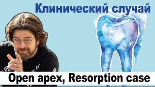 Клинический случай Open apex Resorption case [upl. by Tomkin]