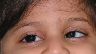 Can eye exercises help in correction of Squint  Dr Sriram Ramalingam [upl. by Suiraj546]