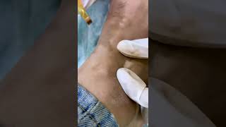 Micropigmentation for Vitiligo  vitiligo skin disease treatment  Skinaa Clinic shorts viral [upl. by Yttak]