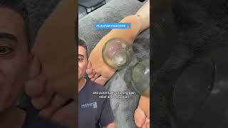 Cupping Therapy for Feet  The Ultimate Plantar Relief Technique [upl. by Oaks]