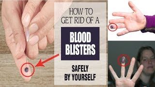 How to Get Rid of a Blood Blister  Blood Blister Home Remedies [upl. by Anh421]