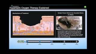 Patient Education Simulation for Hyperbaric Oxygen Therapy [upl. by Ariana]