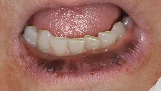 Bizarre Lip Pigmentation Case Dr Nemeths Successful Treatment Revealed [upl. by Collum580]