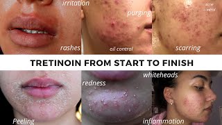 TRETINOIN BEFORE AND AFTER  FULL TRETINOIN EXPERIENCE my journey from start to end Adult Acne [upl. by Uah907]