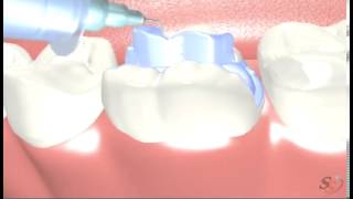 Dental Patient Education Porcelain Inlays Onlays 2 [upl. by Romeu]