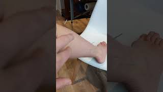 Using acupuncture for peroneal tendonitis [upl. by Aihseya]