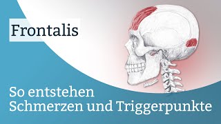 Frontalis Schmerzen Triggerpunkte und deren Aktivierung [upl. by Eliades]