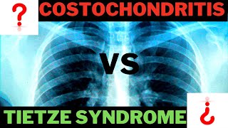 Tietze Syndrome OR Costochondritis [upl. by Aholah456]