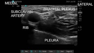 Supraclavicular Brachial Plexus Block Ultrasound guided [upl. by Assiar]