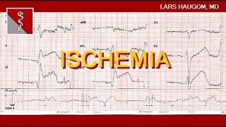 ECG Ischemia [upl. by Iot]