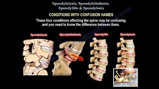 Spondylolysis Spondylolisthesis Spondylitis SpondylosisEverything Need To KnowDr Nabil Ebraheim [upl. by Collis210]