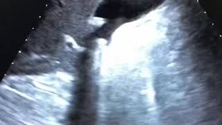 Litiasis vesicular Quiste renal Ecografia abdominal Vesicular lithiasis Renal cyst ultrasound [upl. by Atteoj]