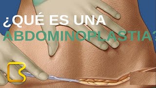 ¿Qué es una abdominoplastia [upl. by Nodnarg]