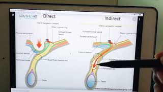 Direct and indirect inguinal hernia [upl. by Niple]