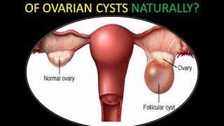 How To Get Rid Of Ovarian Cysts Naturally [upl. by Nicolette]