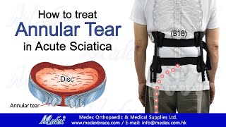 B18  How to treat Annular Tear in Acute Sciatica 3D Animation [upl. by Ssalguod]