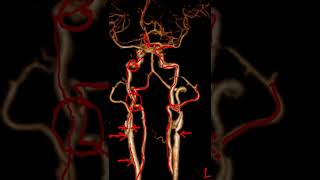 cerebral angiogram  session 4 [upl. by Janie]