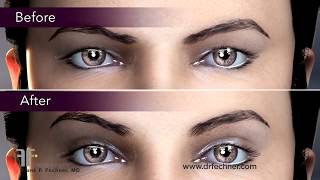 How is a blepharoplasty performed Eyelid Lift Animation by Boston Plastic Surgeon Frank Fechner MD [upl. by Ytsirhk]