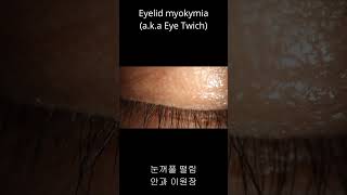 눈꺼풀이 파르르 떨려요 눈떨림 눈꺼풀 떨림 Eyelid myokymia Eye twitch shorts [upl. by Peggy]