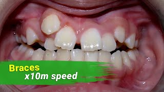 Braces 3 year  x10 milion speed [upl. by Durno622]