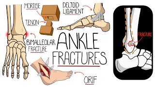 Ankle Fractures Made Easy [upl. by Eniamreg109]