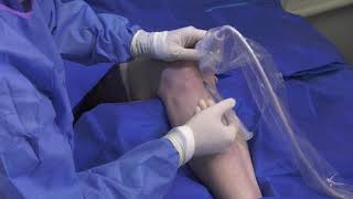 TenJet Patella Tendinosis Minimally Invasive Tenotomy Procedure [upl. by Nev]