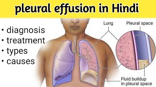 pleural effusion in Hindi  exudative amp transudative  causes diagnosis treatment [upl. by Cissiee]