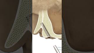 GDT MAX BasalCortical Dental Implant Drilling Protocol [upl. by Blakely]