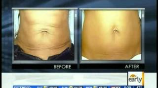 Exilis Body Contouring  Ultrasound Fat Reduction  Exilis Day [upl. by Jackqueline759]