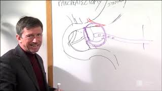 Distal Pancreatectomy Procedure  Roswell Park Patient Education [upl. by Edla109]