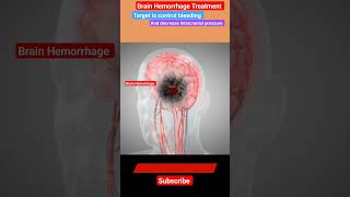 Brain Hemorrhage Treatment l Mannitol l Craniotomy stroke shorts [upl. by Alvita]