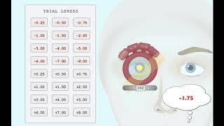 Retinoscopy with trial lenses Minus cylinder [upl. by Treboh]