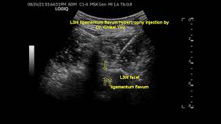 腰椎黃韌帶肥厚注射 by 尤稚凱醫師 lumbar ligamentum flavum hypertrophy by Dr Chikai You [upl. by Grae]