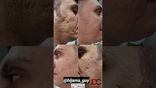 Successful Treatment Of Acne Scars [upl. by Adianes]