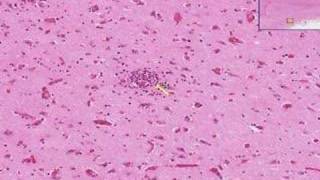 Histopathology Brain Viral encephalitis [upl. by Sell]