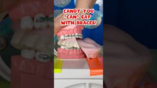 3 BEST and WORST HALLOWEEN CANDY for BRACES  TEETH 🎃👻🦷 braces candy crunchy [upl. by Allyson]