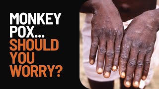 Monkey Pox 2024 Should you be worried [upl. by Stanfield]