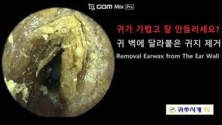 Removal Earwax from The Ear Wall 귀 벽에 붙은 귀지제거 [upl. by Arabela]