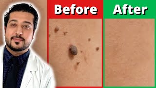 How to Rid Skin Tags FASTER  3 Easy Skin Tag Removal Steps [upl. by Beesley579]